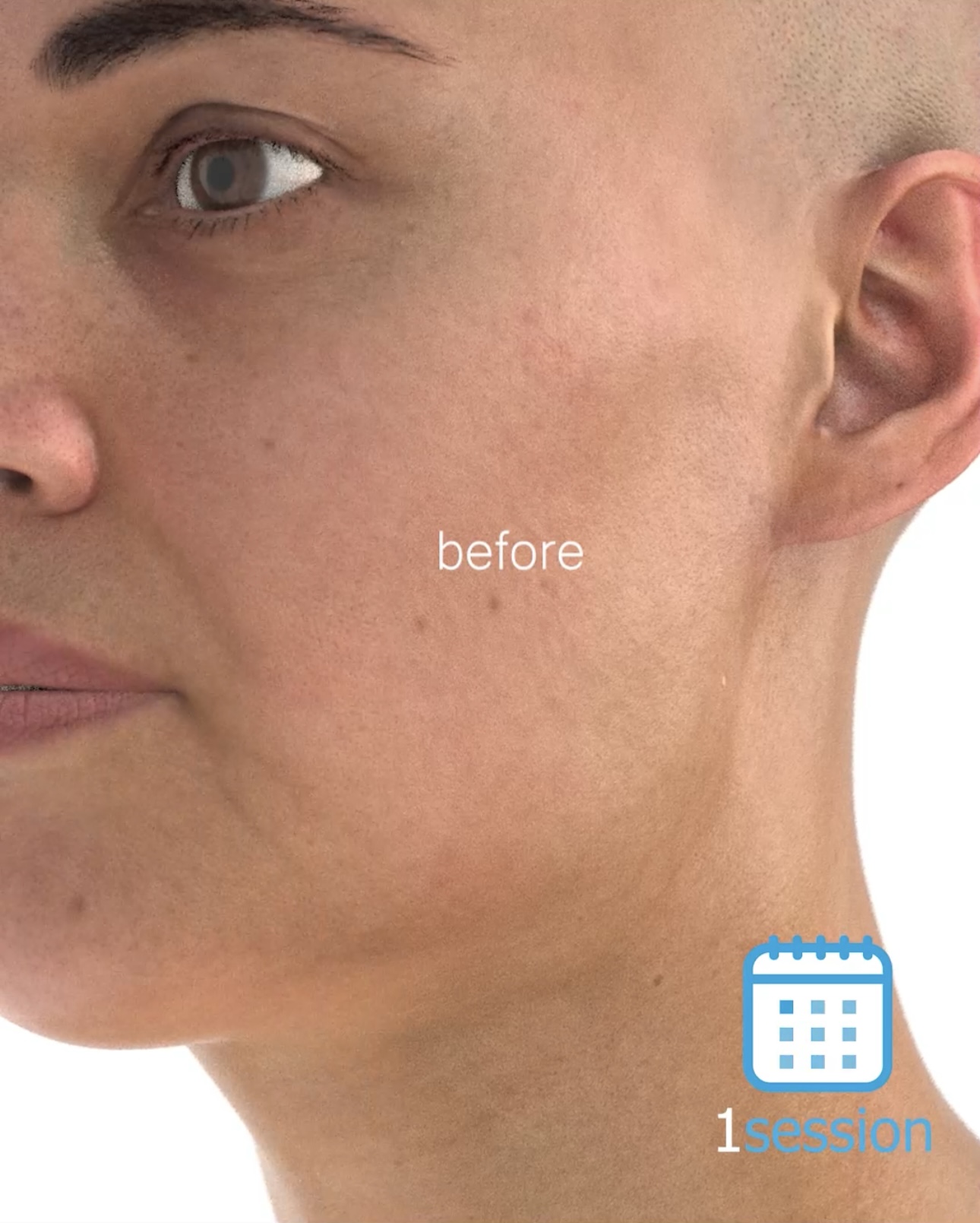 *เป็นภาพแสดงตัวอย่างเท่านั้น ผลลัพธ์ของการรักษา ในแต่ละคนอาจแตกต่างกัน ขึ้นกับสภาพผิว เชื้อชาติ อายุ