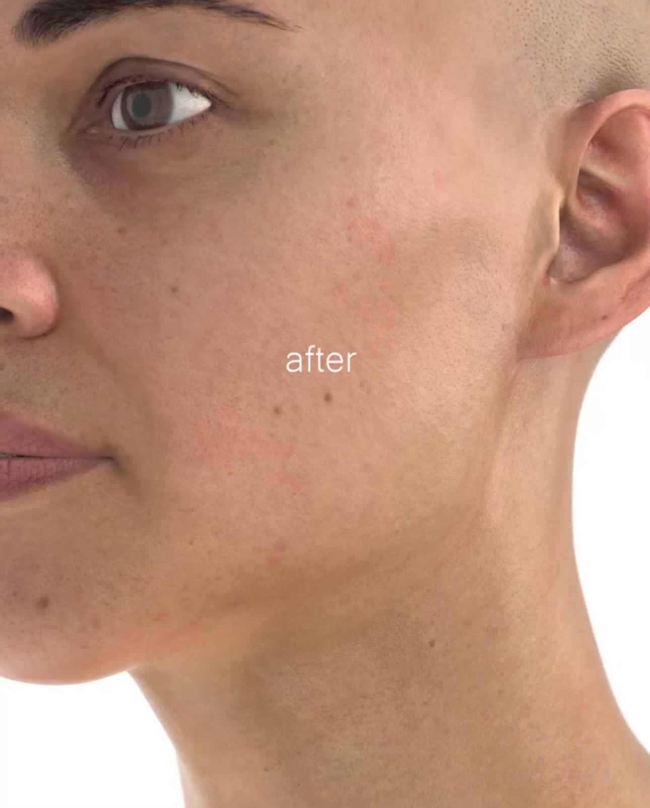 *เป็นภาพแสดงตัวอย่างเท่านั้น ผลลัพธ์ของการรักษา ในแต่ละคนอาจแตกต่างกัน ขึ้นกับสภาพผิว เชื้อชาติ อายุ