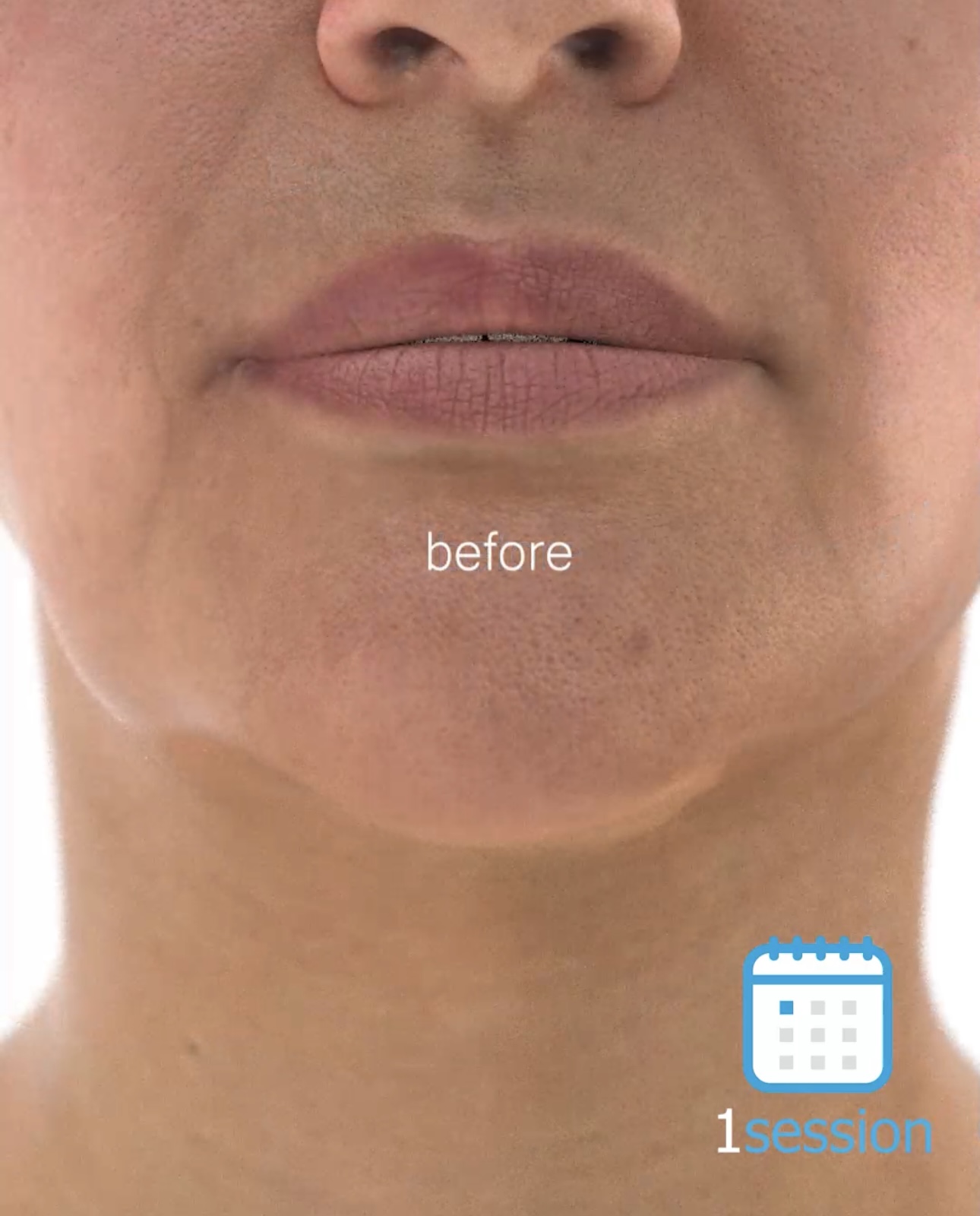 *เป็นภาพแสดงตัวอย่างเท่านั้น ผลลัพธ์ของการรักษา ในแต่ละคนอาจแตกต่างกัน ขึ้นกับสภาพผิว เชื้อชาติ อายุ