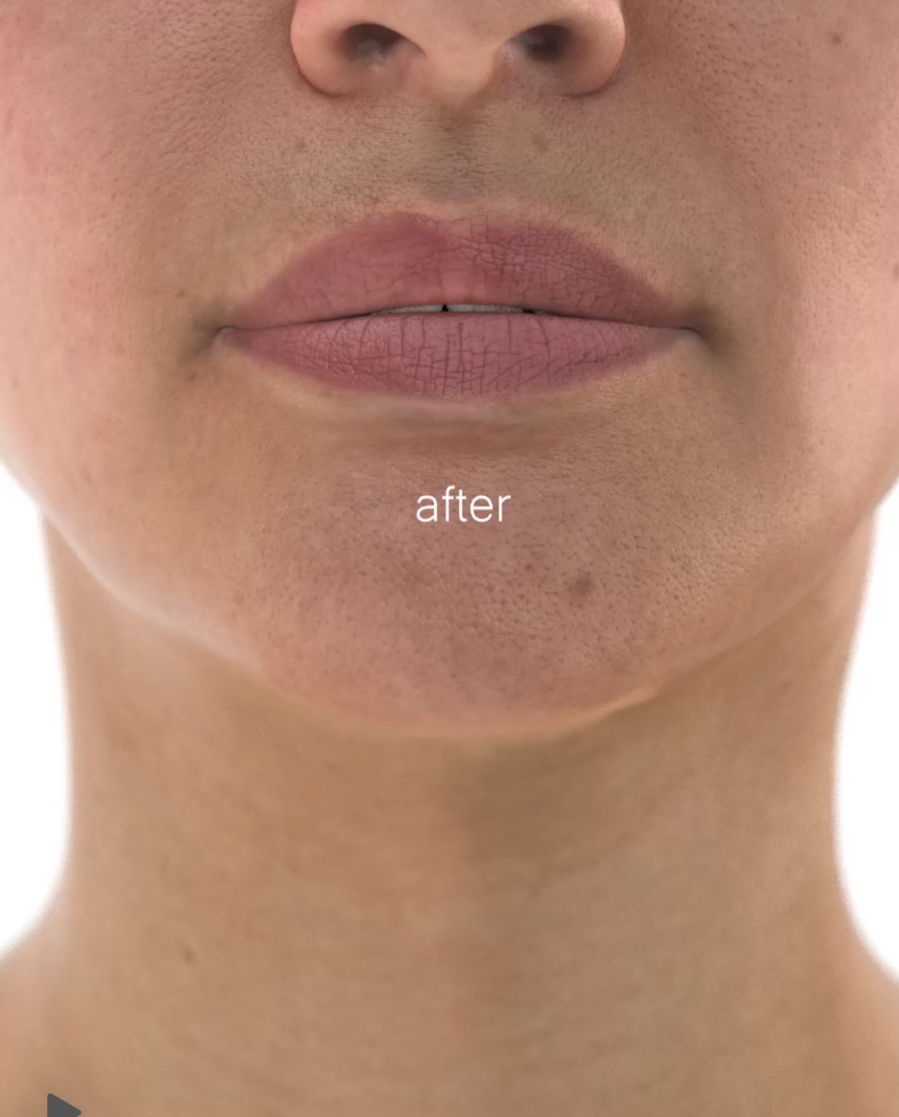 *เป็นภาพแสดงตัวอย่างเท่านั้น ผลลัพธ์ของการรักษา ในแต่ละคนอาจแตกต่างกัน ขึ้นกับสภาพผิว เชื้อชาติ อายุ